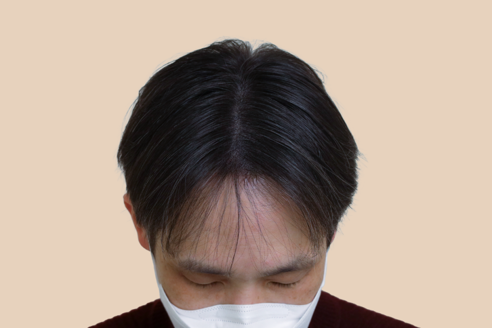 헤어라인 두피문신 결과