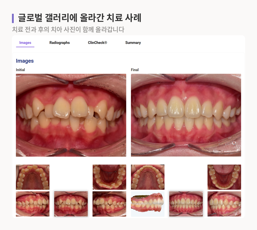 인비절라인 글로벌 갤러리 사례 화면, 치료 전과 치료 후의 치아 사진 묶음