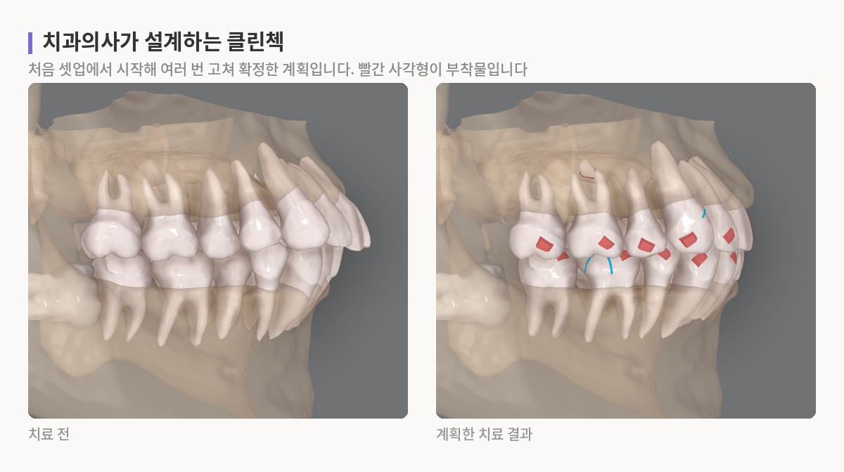 인비절라인 클린첵 화면에서 치료 전 치열과, 부착물을 붙여 배열을 계획한 치료 결과를 나란히 비교한 모습
