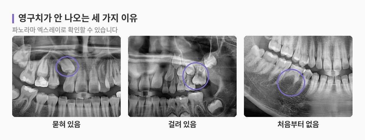 잇몸뼈 속에 묻힌 송곳니, 앞 유치에 걸린 어금니, 영구치 없이 유치만 남은 자리를 표시한 파노라마 엑스레이 세 장