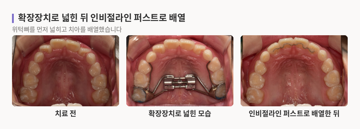 좁고 앞니가 겹친 위 치열, 확장장치를 낀 위턱, 넓어진 치열에 가지런히 배열된 앞니를 차례로 보여주는 교합면 사진 세 장