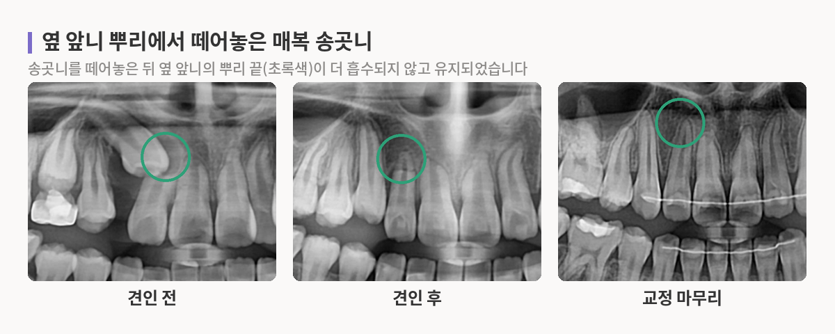 옆 앞니 뿌리와 겹쳐 있던 오른쪽 위 송곳니를 견인해 제자리로 옮기고 교정을 마친 파노라마 엑스레이 세 장, 옆 앞니 뿌리 끝이 유지된 모습