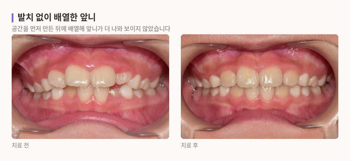어린이 앞니를 정면에서 본 치료 전후 사진. 치아가 겹쳐 있고 나올 공간이 부족한 상태에서, 공간을 만든 뒤 배열해 앞니가 가지런해진 모습