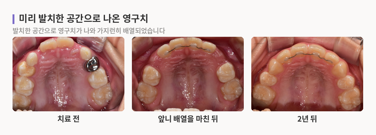어린이 위턱 치열을 위에서 본 사진 세 장. 치아가 나올 공간이 부족했던 상태에서 앞니를 배열하고, 2년 뒤 발치한 공간으로 영구치가 나와 가지런히 배열된 모습