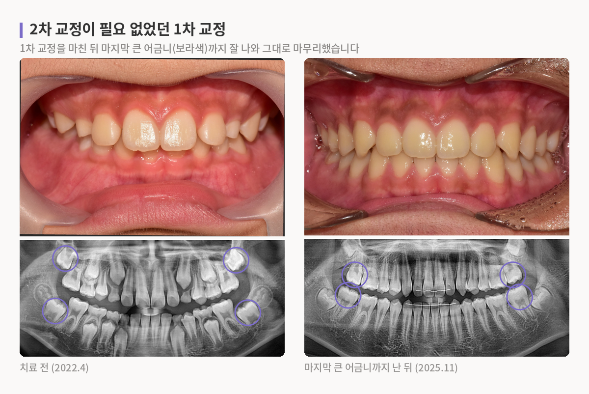 깊게 물리던 앞니가 알맞게 물리게 되고, 치료 전 잇몸 속에 있던 마지막 큰 어금니 네 개가 1차 교정 뒤 모두 나와 배열된 모습을 비교한 정면 사진과 파노라마 엑스레이
