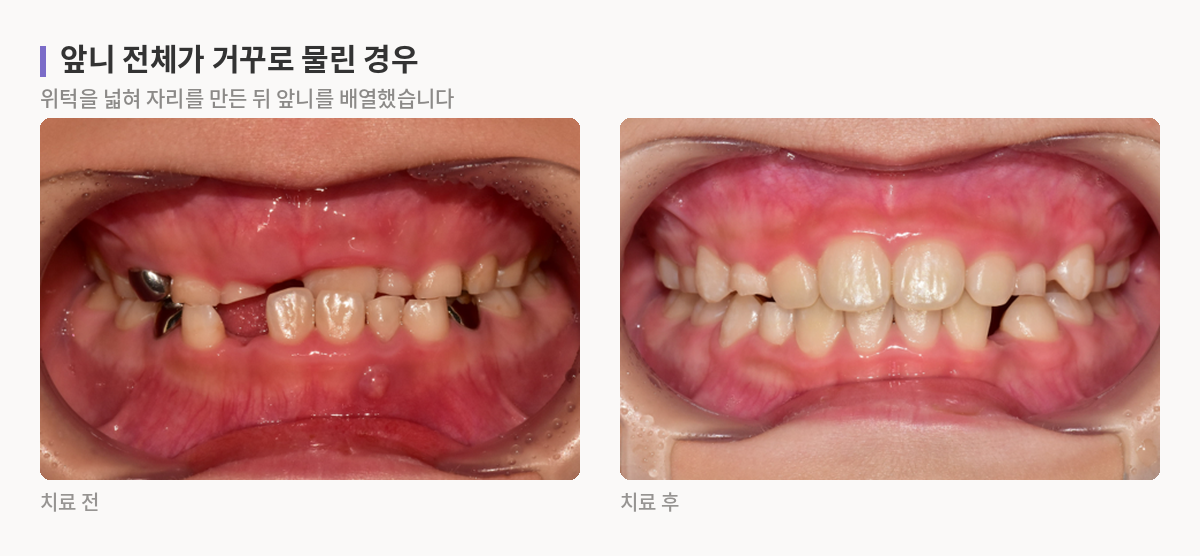 위 앞니가 아래 앞니 안쪽으로 물려 있던 상태와, 위턱을 넓혀 공간을 만든 뒤 앞니를 배열해 정상적으로 물리게 된 상태의 입 안 사진