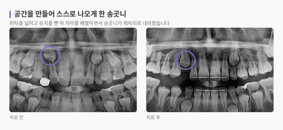 치료 전 높이 있던 오른쪽 위 송곳니가 치료 후 제자리 쪽으로 내려온 파노라마 엑스레이 비교