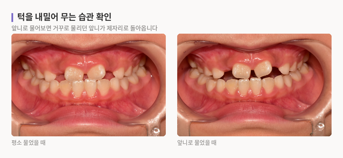 평소 물었을 때와 앞니로 물었을 때의 입 안 사진을 나란히 놓아 앞니 관계가 달라지는 것을 보여주는 모습