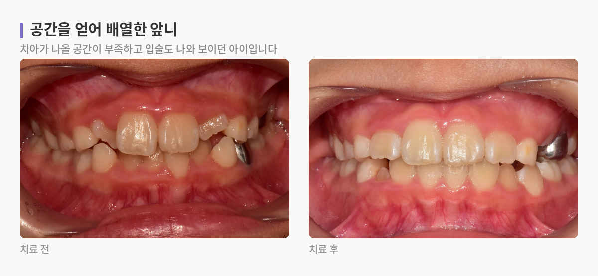 어린이 앞니를 정면에서 본 치료 전후 사진. 치아가 나올 공간이 부족한 상태에서, 위턱을 넓히고 치열을 넓게 배열해 앞니가 가지런해진 모습