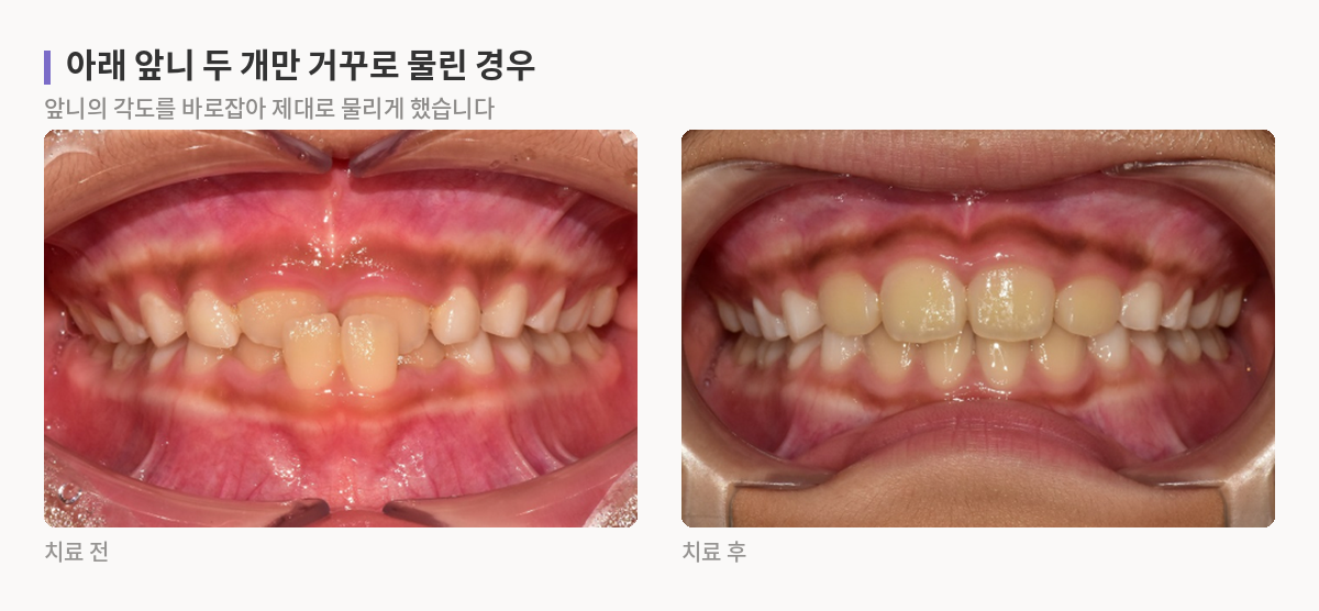아래 앞니 두 개만 위 앞니보다 앞으로 나와 물리던 상태와, 앞니 각도를 바로잡아 정상적으로 물리게 된 상태의 입 안 사진