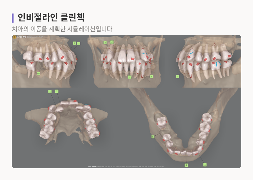 인비절라인 클린첵 시뮬레이션 화면, 위아래 치아 배열과 부착물 위치