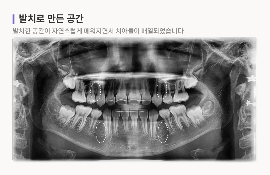 어린이 파노라마 엑스레이. 미리 발치한 작은어금니 네 곳이 점선으로 표시되어 있고, 그 공간이 메워지면서 치아들이 배열된 모습