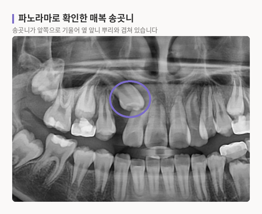 앞쪽으로 기울어 옆 앞니 뿌리와 겹친 오른쪽 위 송곳니를 표시한 파노라마 엑스레이