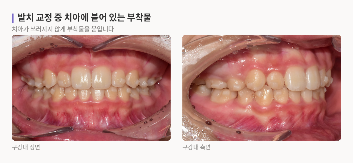 인비절라인 발치 교정 중 여러 치아에 붙인 부착물이 보이는 구강내 정면 사진과 측면 사진